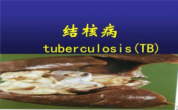 防治结核病演讲稿7篇