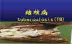 防治结核病演讲稿7篇